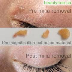 milia removal extraction - Toronto Ontario