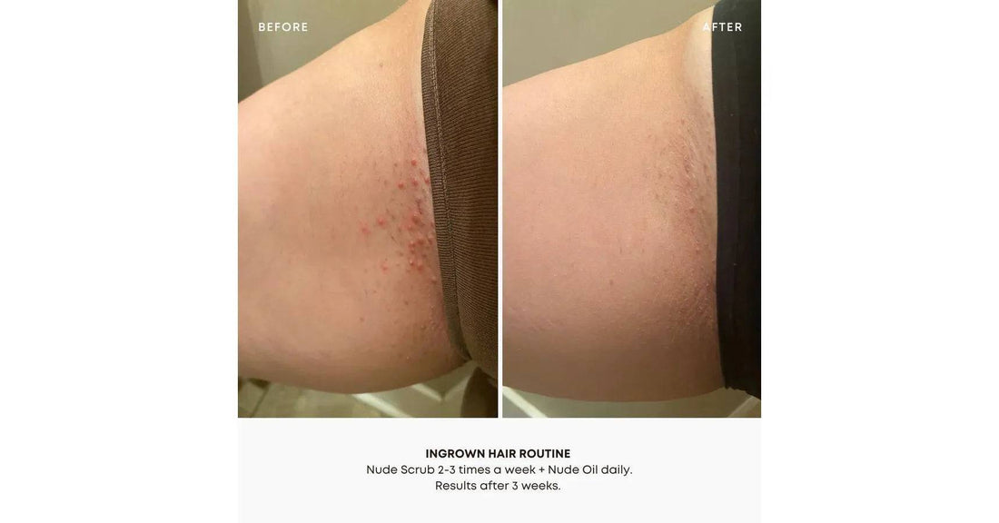 Nude Ingrown Hair Oil (30 ml-1 oz)