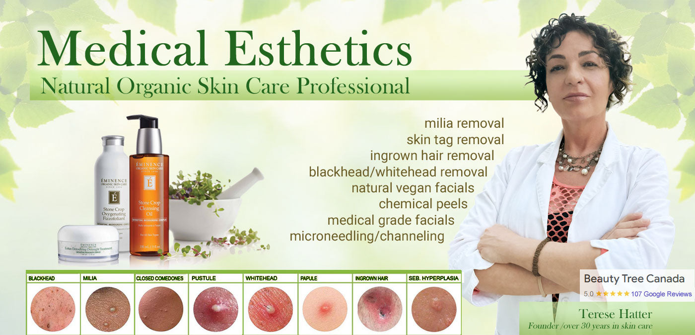 Milia removal Toronto Ontario Beauty Tree