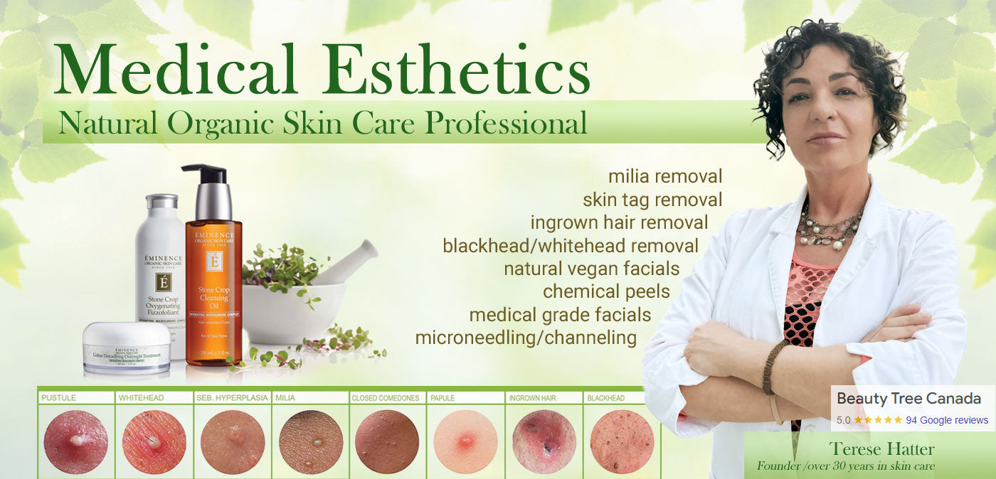 Milia removal Toronto Ontario Beauty Tree