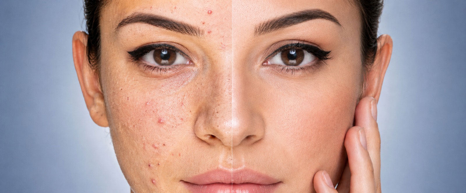 Toronto acne facials and treatments