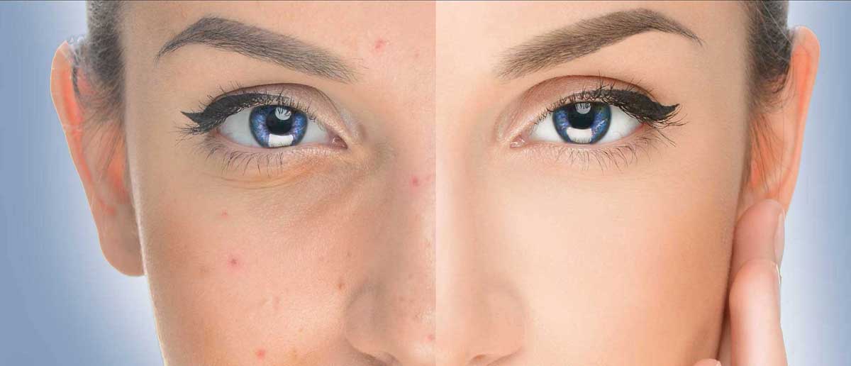 Toronto acne facials and treatments