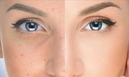 Toronto acne facials and treatments